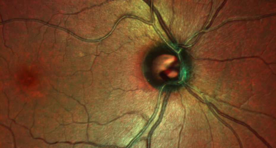 Complications of diabetes retina