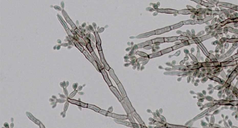 Microscopic image of Chromoblastomycosis